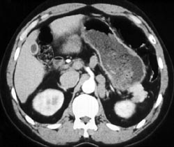 Chronic Cholecystitis and Varices Simulating A Left Adrenal Mass - CTisus CT Scan