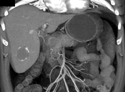 Hemangioma - CTisus CT Scan