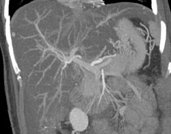 Fatty Liver With 1 Cm Hepatoma - CTisus CT Scan