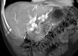 Cavernous Transformation of the Portal Vein - CTisus CT Scan