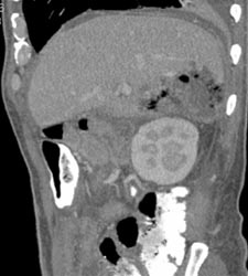 Liver Abscess - CTisus CT Scan