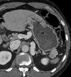 Varix Simulates Adrenal Mass (see Prior Case) - CTisus CT Scan