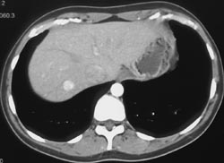 Focal Nodular Hyperplasia (FNH) - CTisus CT Scan