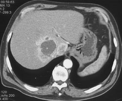 Liver Invasion From A Primary Adrenal Mass - CTisus CT Scan