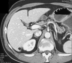 Lipoma of the Liver - CTisus CT Scan