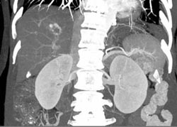 Hemangioma - CTisus CT Scan