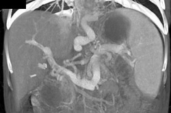 Huge Dilated Veins Due to Portal Hypertension - CTisus CT Scan