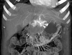 Hemangioma of the Left Lobe - CTisus CT Scan