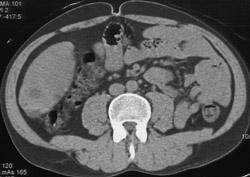 Hepatoma - CTisus CT Scan