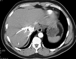 Reflux Into Inferior Vena Cava (IVC) - CTisus CT Scan