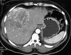 Metastatic Carcinoid (see Tumor at Ligament of Treitz) - CTisus CT Scan