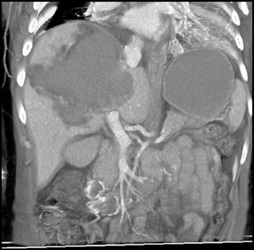 Hepatic Hematoma - CTisus CT Scan