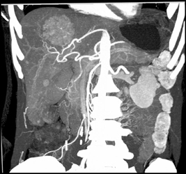 Hepatic Adenoma - CTisus CT Scan