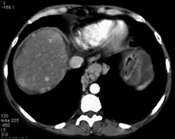 Regenerating Nodules in Cirrhotic Liver - CTisus CT Scan