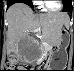 Gallbladder Cancer - CTisus CT Scan