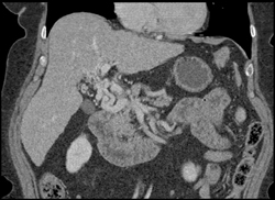 Cavernous Transformation of the Portal Vein - CTisus CT Scan