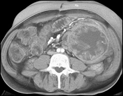 Rf Changes Liver With Retained Towel (oops!) in Left Lower Quadrant - CTisus CT Scan