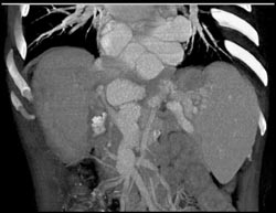 Huge Esophageal Varices - CTisus CT Scan