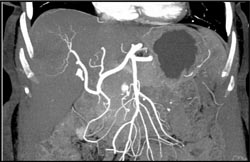 Post Rf Changes - CTisus CT Scan