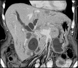 Cholangiocarcinoma - CTisus CT Scan