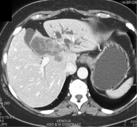 Cholangiocarcinoma - CTisus CT Scan