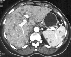 Peliosis Hepatis - CTisus CT Scan