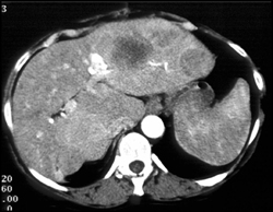 Metastatic Disease From Lung Cancer - CTisus CT Scan