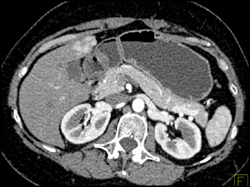 Focal Nodular Hyperplasia (FNH) - CTisus CT Scan