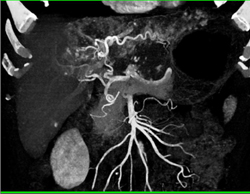 Giant Hemangioma - CTisus CT Scan