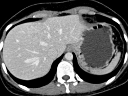 Focal Nodular Hyperplasia (FNH) - CTisus CT Scan