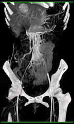Focal Nodular Hyperplasia (FNH) - CTisus CT Scan