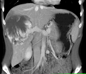 Giant Cavernous Hemangioma - CTisus CT Scan