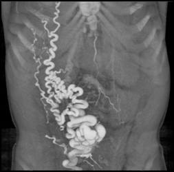 Cirrhosis With Large Abdominal Wall Varices Due to Portal Hypertension - CTisus CT Scan