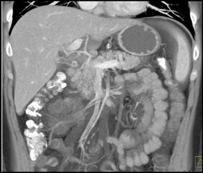Mirizzi Syndrome - CTisus CT Scan