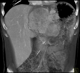 Hepatoma With Neovascularity - CTisus CT Scan