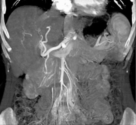 Transjugular Intrahepatic Portosystemic Shunt (TIPS) With Hepatic Artery Aneurysm - CTisus CT Scan