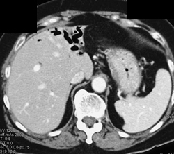 Pneumobilia - CTisus CT Scan