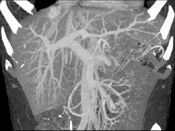 Focal Nodular Hyperplasia (FNH) - CTisus CT Scan