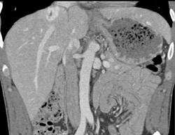Focal Nodular Hyperplasia (FNH) - CTisus CT Scan