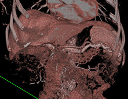 Encased But Patent Portal Vein (PV) - CTisus CT Scan