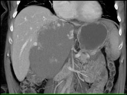 Giant Cavernous Hemangioma - CTisus CT Scan