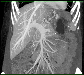 Giant Cavernous Hemangioma - CTisus CT Scan