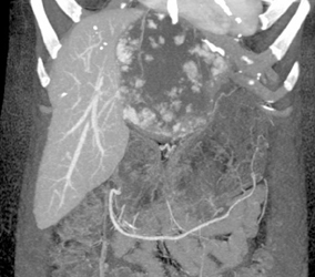 Giant Cavernous Hemangioma - CTisus CT Scan