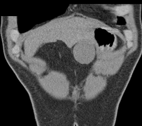 Hemangioma Simulates An Arterial Phase Imaging and Gastric Duplication - CTisus CT Scan