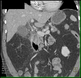 Stones in Common Bile Duct (CBD) - CTisus CT Scan