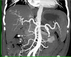 Hepatoma - CTisus CT Scan