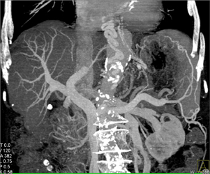 Cirrhosis With Varices - CTisus CT Scan