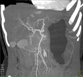 Hepatoma - CTisus CT Scan