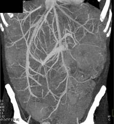 Metastatic Carcinoid Tumor - CTisus CT Scan