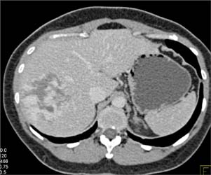 Giant Hemangioma - CTisus CT Scan